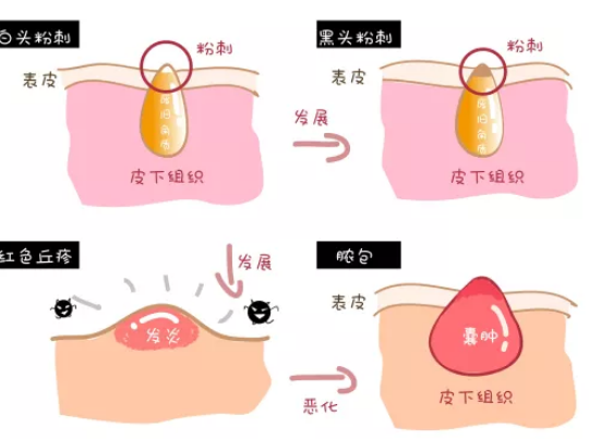 消灭痘印痘坑，你要知道应该怎么做？